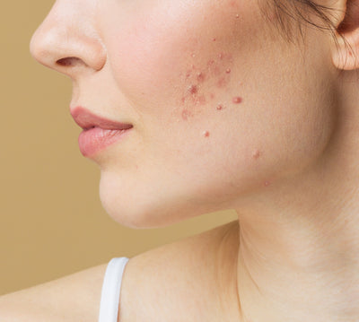 Before image for Acne