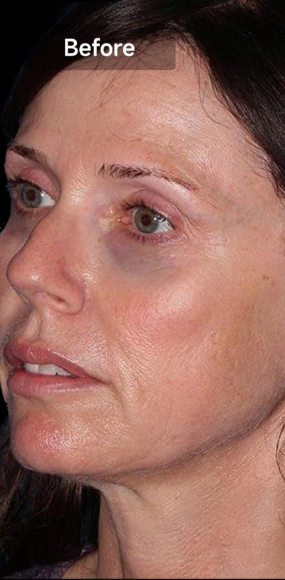 Before image for Dark Circles