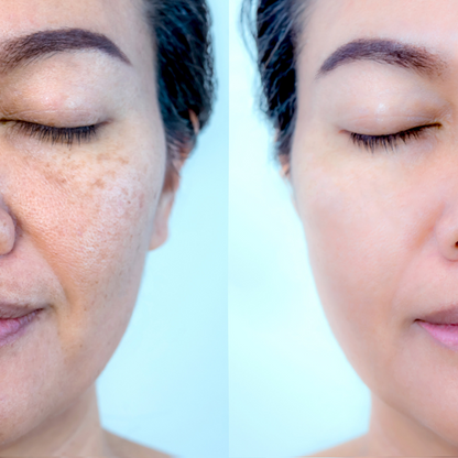 Lumina Red™ LED Face & Neck Mask ElderonPlus