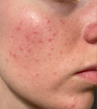 Before image for Inflammation