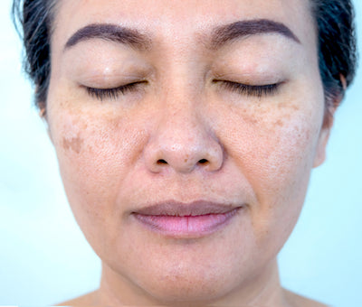 Before image for Pigmentation