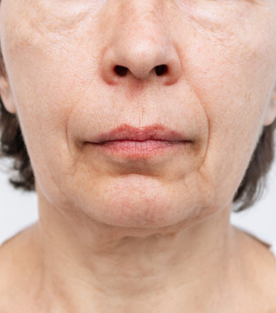 Before image for Wrinkles